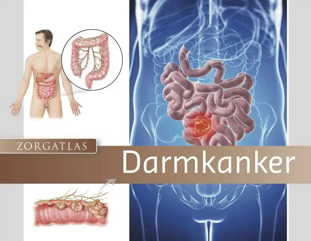 Zorgatlas Darmkanker / Druk 1 Koop Online